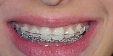 Bagues Dentaires - Appareil Dentaire Céramique Transparente
