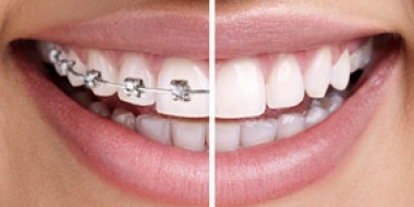 Traitement d'Orthodontie Enfant et Adulte