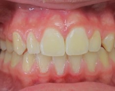Photo Après Appareil Dentaire Bagues Métalliques - Orthodontie Enfant
