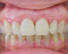 Après Appareil Dentaire Invisible : Bagues Dentaires Céramique Transparente