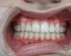 Bagues Dentaires Orthodontie Adolescent