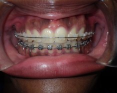 Bagues Dentaires Orthodontie Jeune Adulte