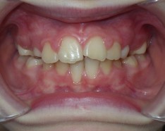 Dents en Avant : Après Traitement d'Orthodontie Enfant