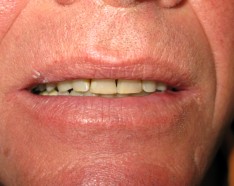 Après Traitement Orthodontie Adulte Dents du Bonheur