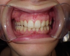Traitement par Bagues Dentaires Dents Ectopiques
