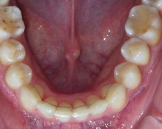 Orthodontie Adulte Traitement Encombrement Dentaire