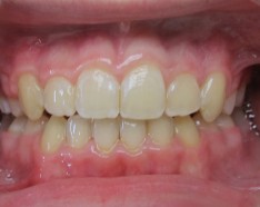 Orthodontie Enfant : Alignement des Dents