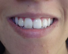 Traitement Orthodontie Linguale Absence Dents