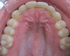 Traitement d'Orthodontie : Encombrement Dentaire