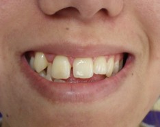Appareil Dentaire Lingual Pour Absence de Dents