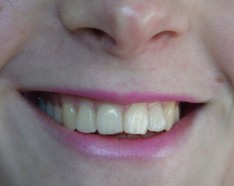 Problème d'Alignement des Dents Orthodontie Adulte