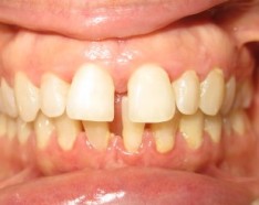 Avant Bagues Dentaires - Appareil Dentaire Céramique Transparente