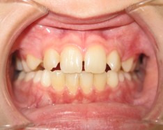 Correction Alignement des Dents - Orthodontie Enfant