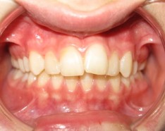 Bagues Dentaires Pour Corriger Défaut d'Alignement des Dents