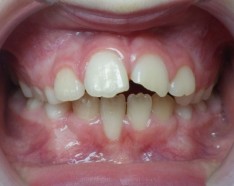 Dents en Avant - Traitement Orthodontie Enfant