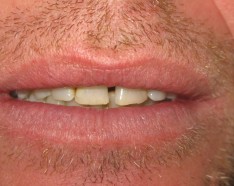Dents Bonheur Traitement Orthodontie Adulte