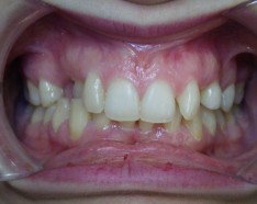 Dents Ectopiques Orthodontie Adulte