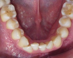 Encombrement Dentaire Orthodontie Adulte