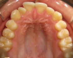 Encombrement Dentaire Orthodontie Adolescent