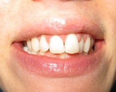 Occlusion Dentaire et Problème d'Alignement des Dents