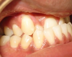 Patient Prognathe Chirurgie et Bagues Dentaires