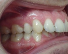 Patient Retrognathe Avant Orthodontie Linguale Incognito