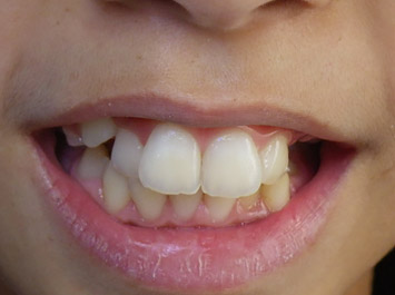 Traitement Orthodontie Enfant