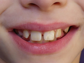 Traitement d'Orthodontie Enfant