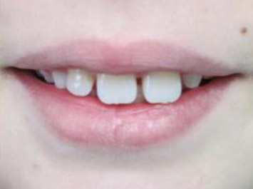 Traitement d'Orthodontie