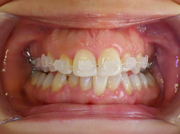 Appareil Dentaire Céramique Transparente : Bagues