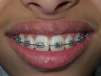Bagues Dentaires : Appareil Dentaire Métallique