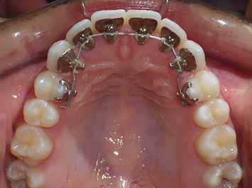 Orthodontie Linguale Incognito