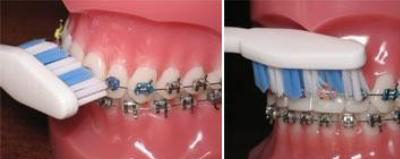 Brossage des Dents avec Appareil Dentaires Bagues