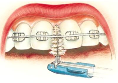 Brossettes Inter Dentaires pour Bagues Dentaires