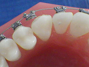 Urgence Orthodontique : Cabinet Orthodontie