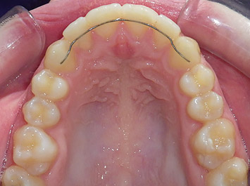 Contention Orthodontique Enfant