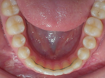 Dépose Appareil Dentaire Contention Orthodontique 