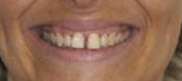 Alignement des Dents Orthodontie Adulte