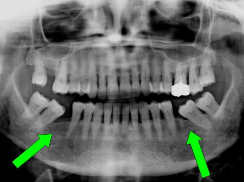 Traitement d'Orthodontie Adulte Pré Prothétique