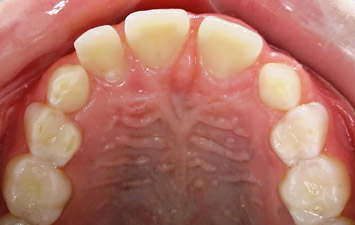 Agénésie Dentaire : Orthodontie Enfant