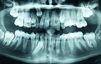 Dent Incluse Orthodontie Enfant