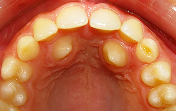 Dent Ectopique Orthodontie Enfant