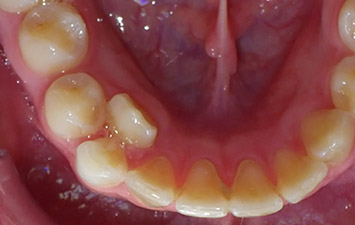 Orthodontie Chez l'Enfant : Dent Ectopique
