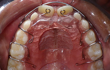 Plaque de Hawley Orthodontie Enfant