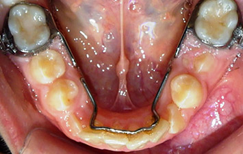 Arc Lingual Inférieur Appareil Dentaire