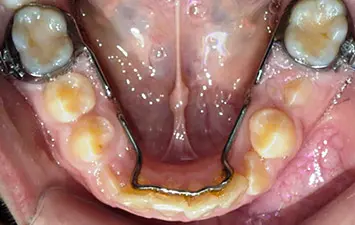 Les Appareils Dentaires Enfants Proposés Par l\'Orthodontiste Les Appareils Dentaires Enfants Proposés Par l\'Orthodontiste