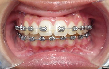 Appareil Dentaire Métallique : Bagues