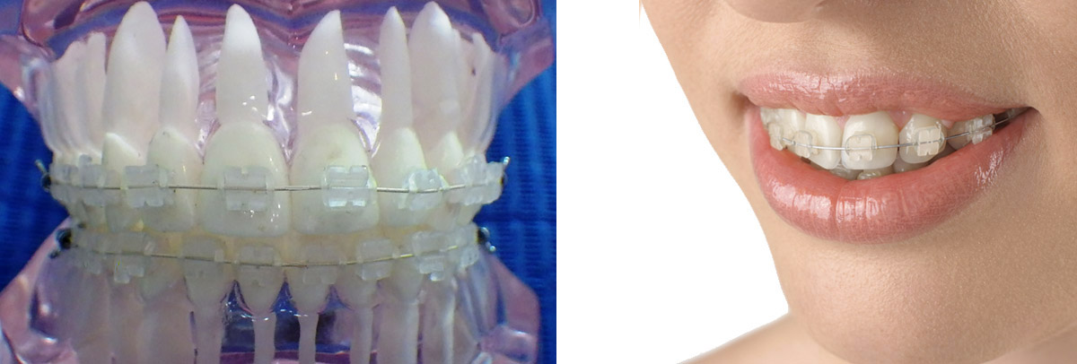 appareils dentaires transparents céramique - bagues dentaires transparentes