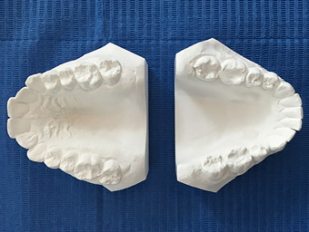 Traitement d'Orthodontie : Empreintes