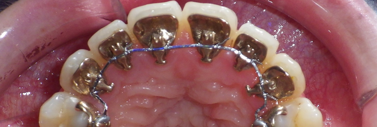 Appareil Dentaire Lingual - Orthodontie Linguale